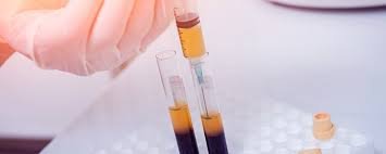 platelet rich plasma.jpg