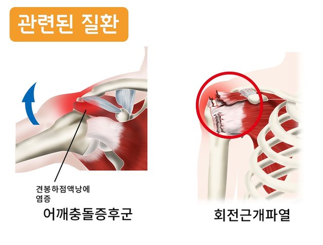 극상근 관련 질환 통인한의원.jpg