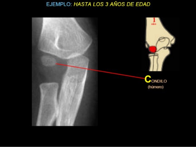 4-fx-humero-distal-nios-dr-miguel-mite-21-638.jpg