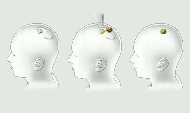 neuralink-installation (1).webp