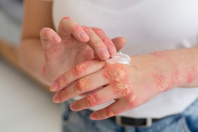 best eczema cream for adult.jpg