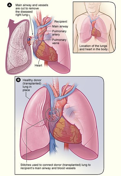 Lung_transplant.jpg