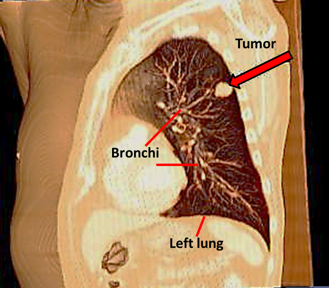 Tumor_in_L._lung-3D_CT_volume_rendering.png