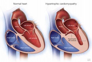 a-medical-illustration-of-a-normal-heart-and-one-with-hypertrophic-cardiomyopathy-original-300x204.jpg