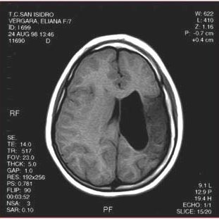 Figura-5-Lesion-isquemica-periventricular-en-hemisferio-izquierdo-en-una-paciente-con_Q320.jpg