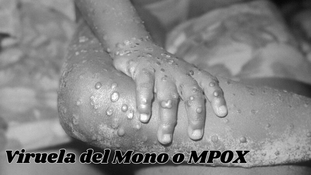 VIRUELA DEL MONO o MPOX (1).png