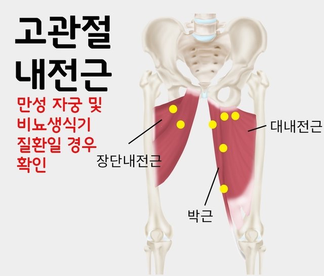 고관절 내전근 종로한의원.jpg