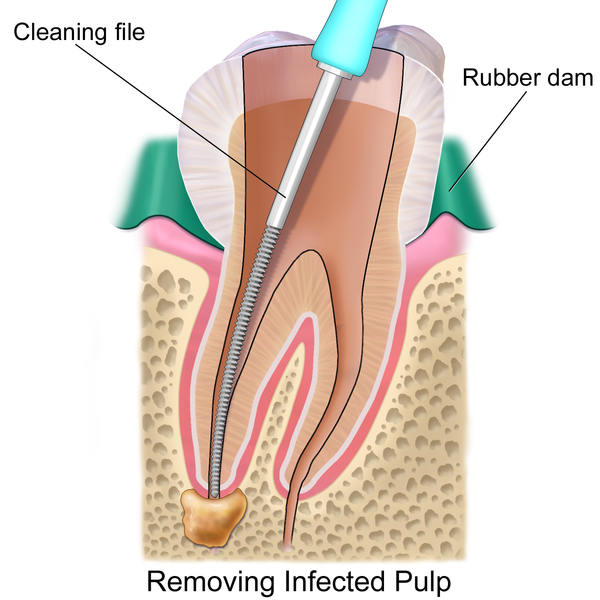 600px-Blausen_0774_RootCanal.png