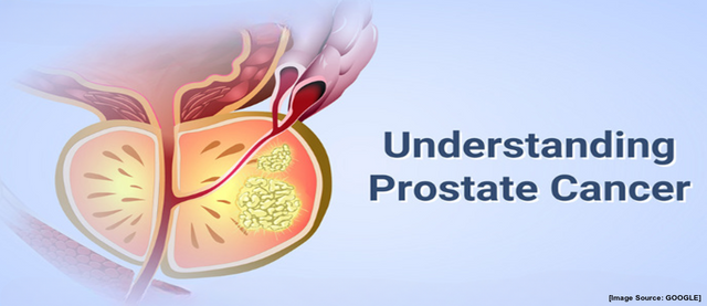 Understanding Prostate Cancer.png