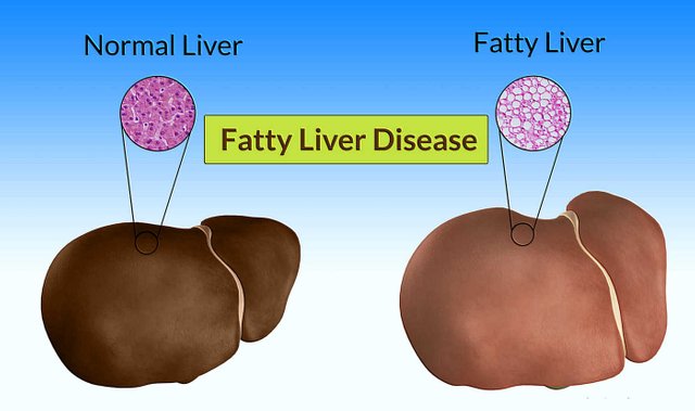 Fatty-Liver-Disease.jpg
