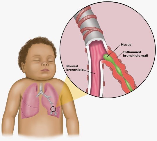 Bronchiolitis  Penyakit Saluran Pernafasan Yang Meradang Di Paru-paru.jpg