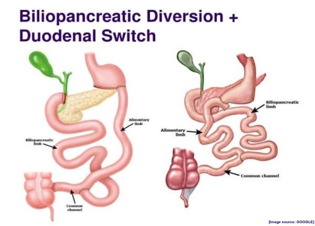 Biliopancreatic Diversion with Duodenal Switch.jpg