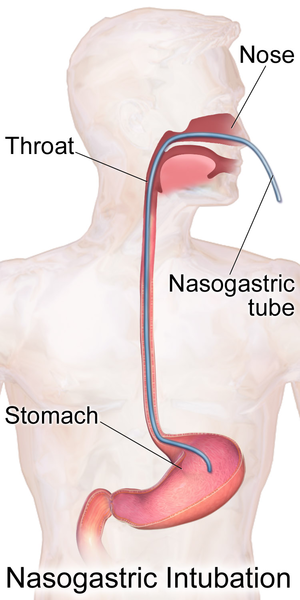 300px-Nasogastric_Intubation.png