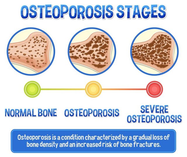 informative-poster-osteoporosis-human-bone_1308-131714.jpg