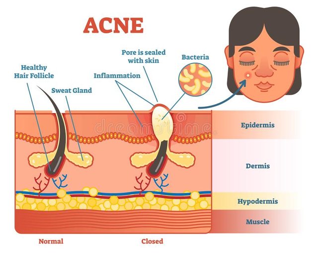 acne-diagram-illustration-hair-pimple-skin-layers-structure-female-face-alongside-educational-medical-informat-acne-107604241.jpg