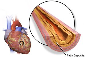 300px-Blausen_0257_CoronaryArtery_Plaque.png