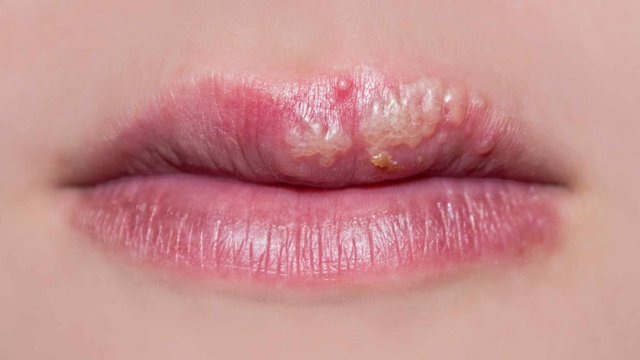 close-up-of-a-womans-lips-with-cold-sores-16X9-1024x576.jpg