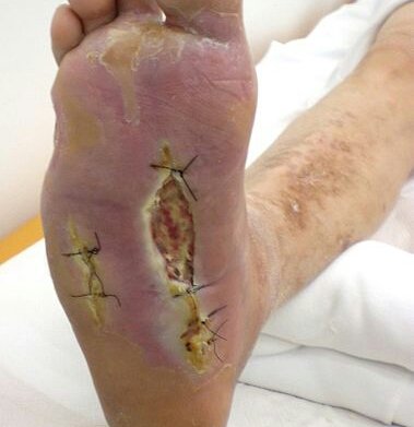 Diabetic_Foot_Syndrome-1.jpg