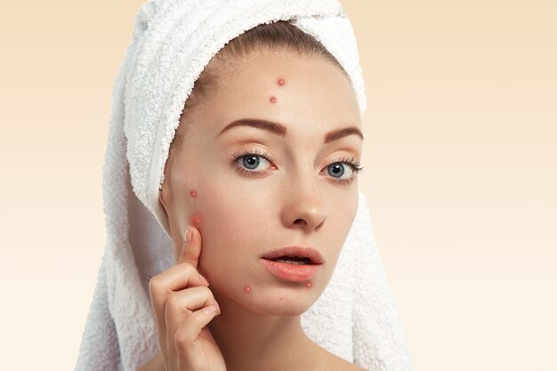 closeup-young-woman-with-towel-head-pimples-face_273609-14431.jpg