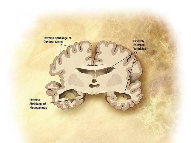 Alzheimer's_disease_brain_severe (1).jpg