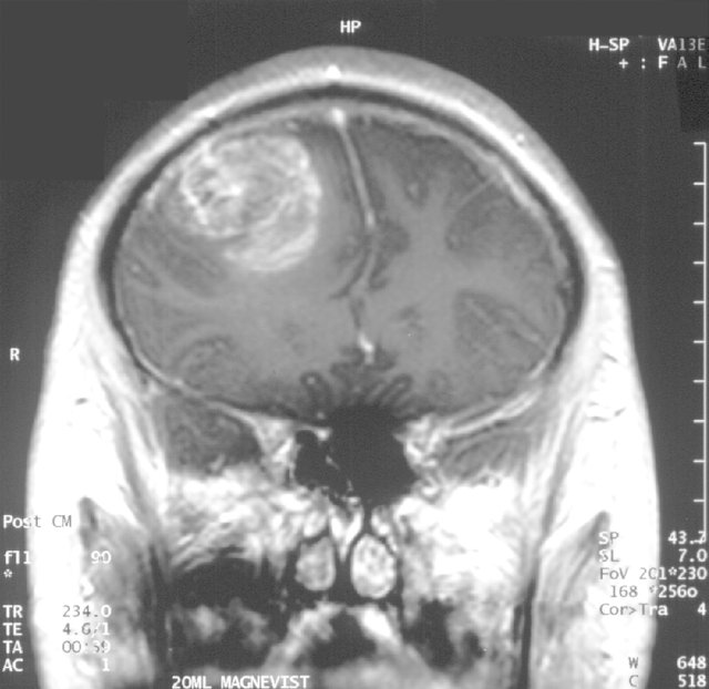 brain tumor.jpg