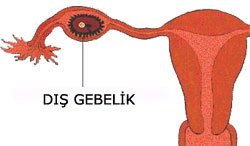 dis-gebelik.jpg