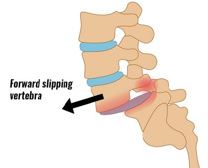 what-is-spondylolisthesis.jpg