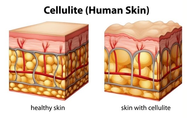 Cellulite-Treatment-in-New-York-Smooth-Solutions-Med-e1446749912591.jpg