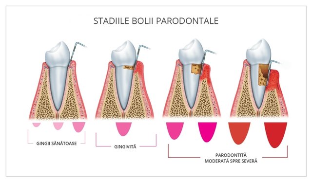 boala-parodontala.jpg