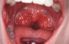 10-02-56-tonsillitis.jpg
