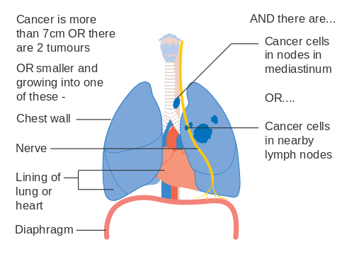 Diagram_2_of_3_showing_stage_3A_lung_cancer_CRUK_014.svg.png