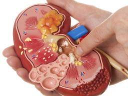 diseased-kidney-model.jpg