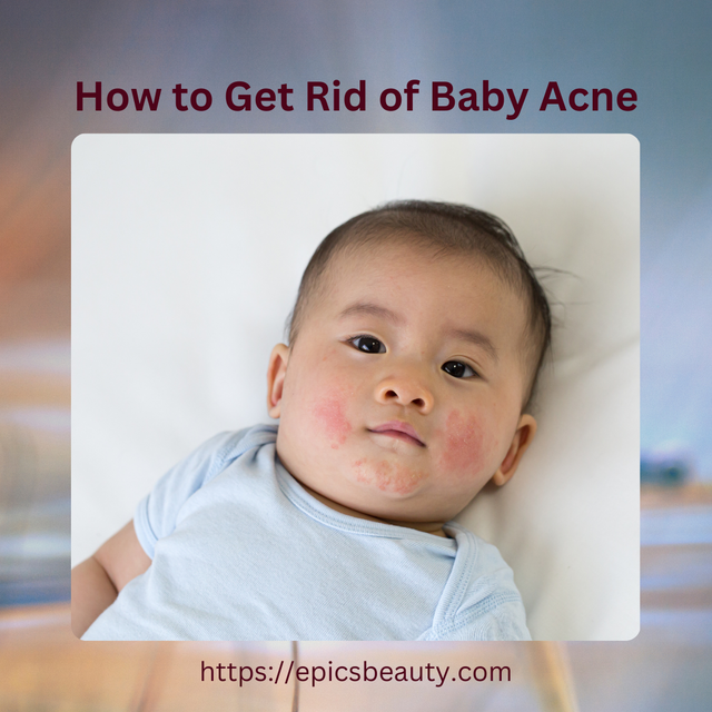 Baby Acne.png