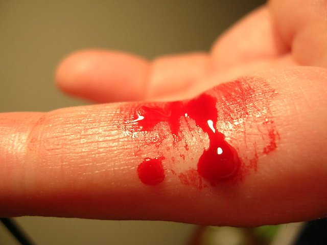 800px-Bleeding_finger.jpg