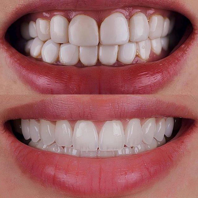 veneers.jpg