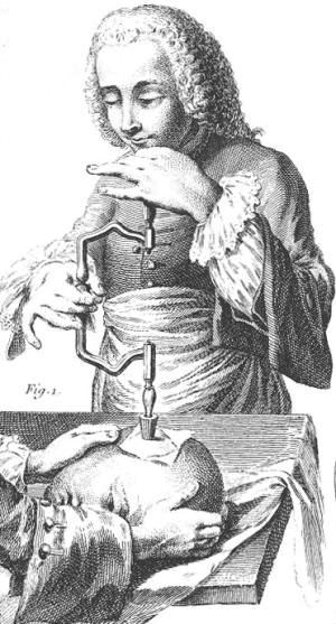 Trepanation illustration France 1800s public domain unknown author.jpg