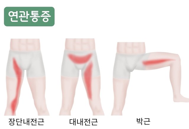 고관절 내전근 연관통증 종각한의원.jpg