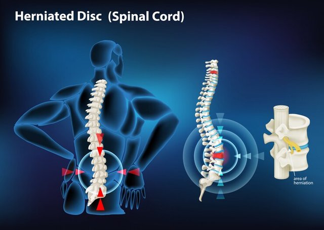 diagram-showing-herniated-disc-human_1308-34255.jpg