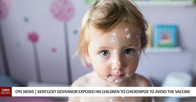 kentucky-governor-exposed-children-chickenpox-instead-of-vaccine.jpg