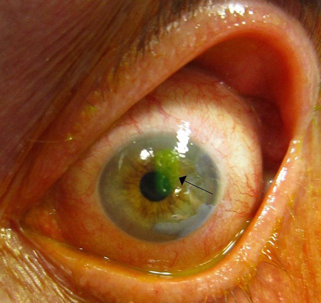 1280px-Human_cornea_with_abrasion_highlighted_by_fluorescein_staining.jpg