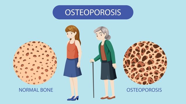 bone-density-osteoporosis-vector_1308-131004.jpg