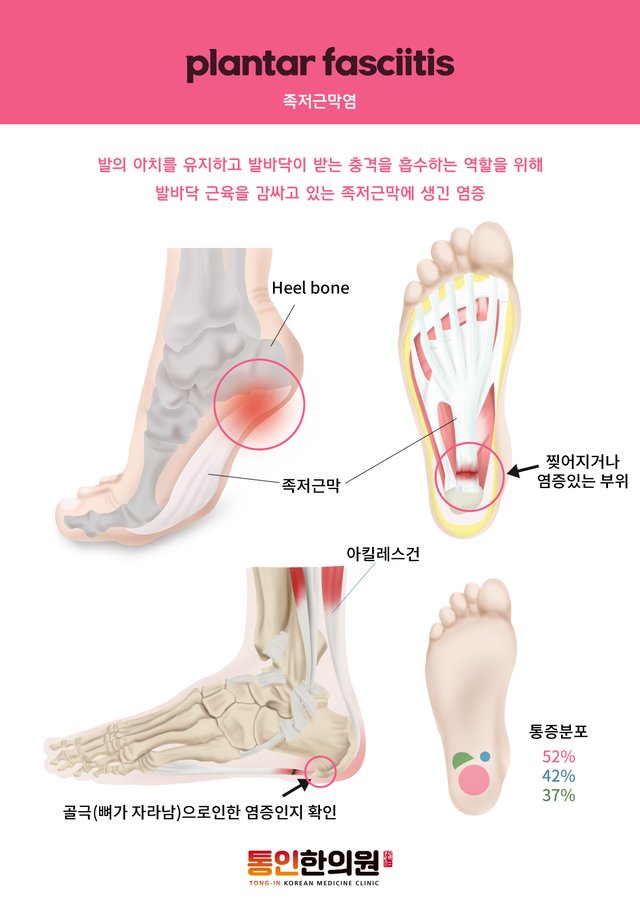 족저근막염.jpg