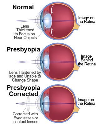 Presbyopia-Diagram.jpg