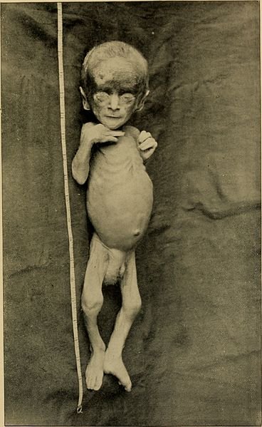 An_American_text-book_of_the_diseases_of_children_(1895)_(14782046202).jpg
