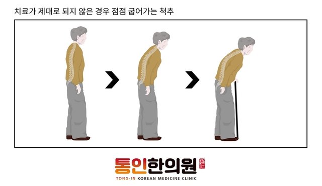 척추압박골절 꼬부랑할머니 종각한의원.jpg