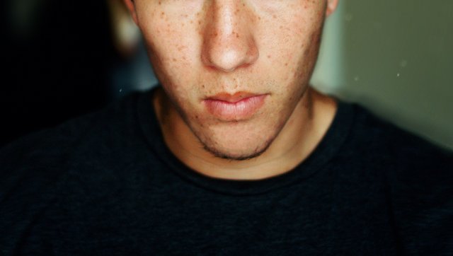 Male_Skin_Freckles.jpg