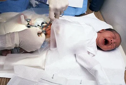 newborn-circumcision.webp