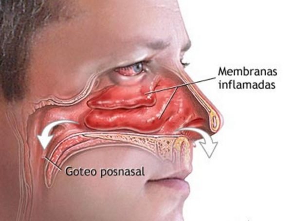 sinusitis2.jpg