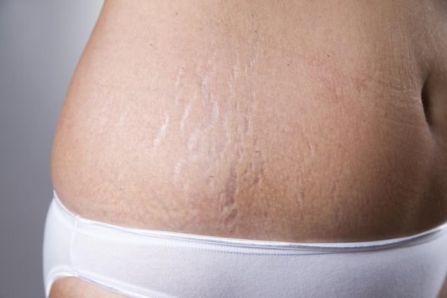 stretch-marks.jpg