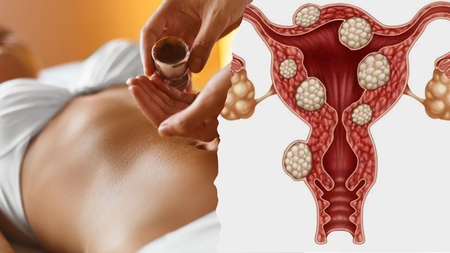 Aromatherapy For Uterine Fibroids Treatment.jpg